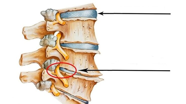 ушкодження хребта при шийному остеохондрозі