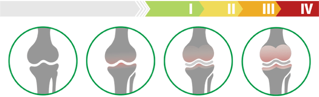Клінічні стадії артрозу колінного суглоба (ступінь артрозу колінного суглоба)