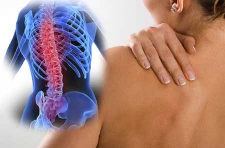 Під час загострення остеохондрозу грудного відділу хребта виникають болі дорсаго